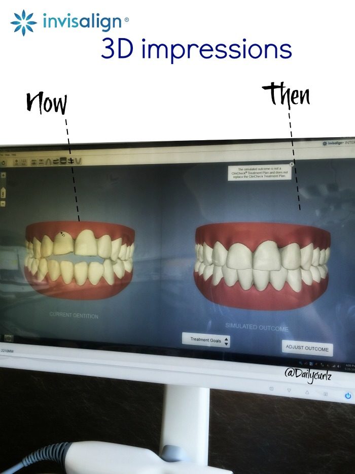invisalign impression and appointment