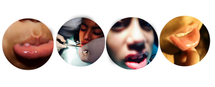 mucocele removal