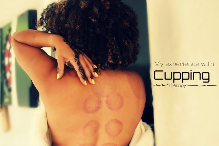 My Experience With Cupping For Lower Back Pain